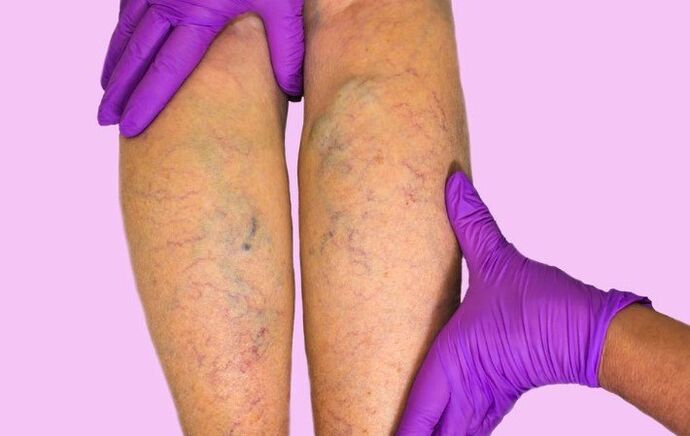 Varicose veins on the lower leg