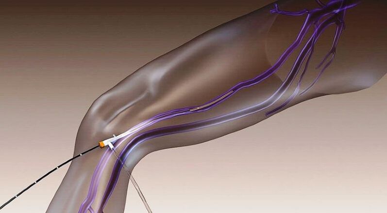 Radiofrequency obliteration - a method of treating varicose veins